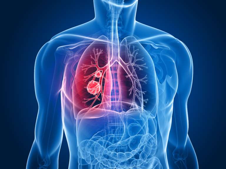 Immunotherapy Over Chemotherapy for Mesothelioma