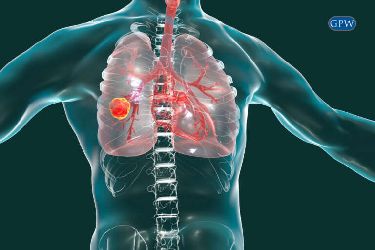 September is Mesothelioma Awareness Month