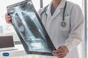 Microplastics Can Be Found in Large Amounts of People With Lung Cancer