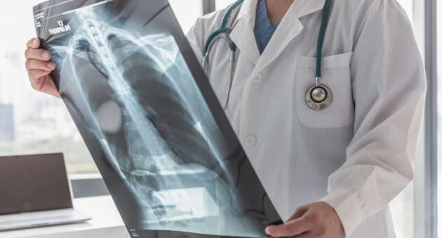 Asbestos-caused Lung Cancer: Understanding Risks and Prevention