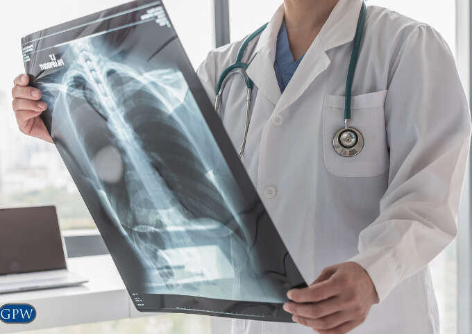 Asbestos-caused Lung Cancer: Understanding Risks and Prevention