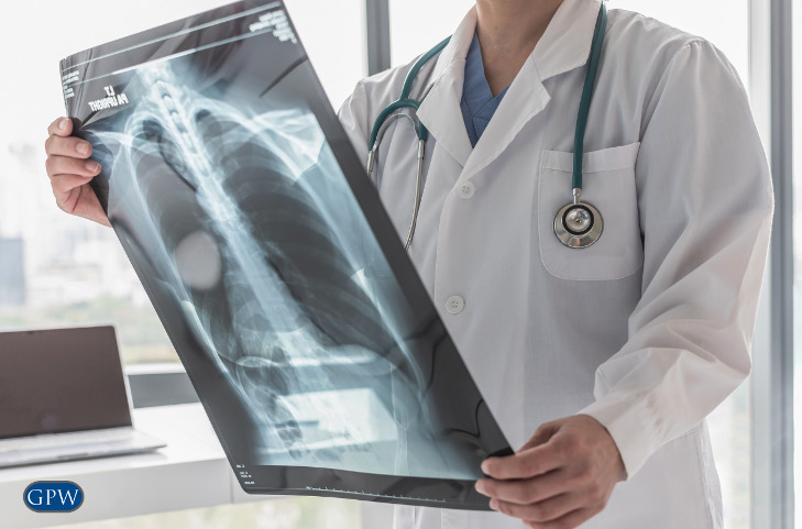 Asbestos-caused Lung Cancer: Understanding Risks and Prevention