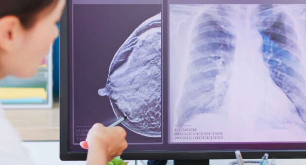 High- Risk Individuals May Consider Mesothelioma Screening for Early Detection