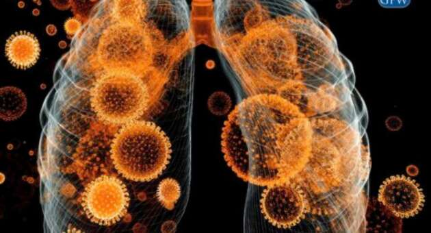 Pulmonary Fibrosis vs. Asbestosis: Understanding the Differences and Your Legal Rights