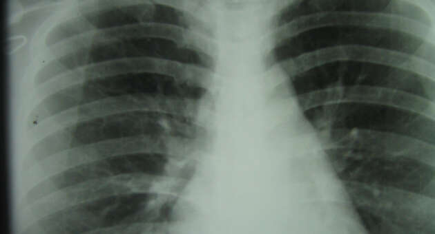 Recent Studies Show Increase in Mesothelioma Among Younger Patients
