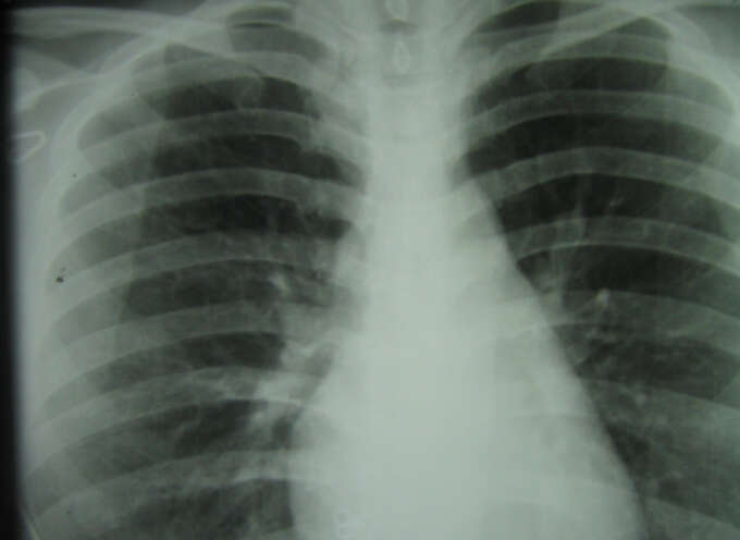Recent Studies Show Increase in Mesothelioma Among Younger Patients