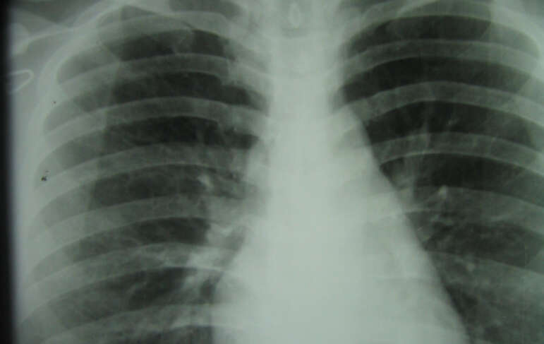Recent Studies Show Increase in Mesothelioma Among Younger Patients
